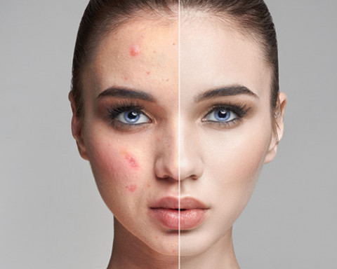 Nos astuces anti-imperfections pour une peau parfaite