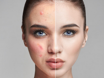 Nos astuces anti-imperfections pour une peau parfaite