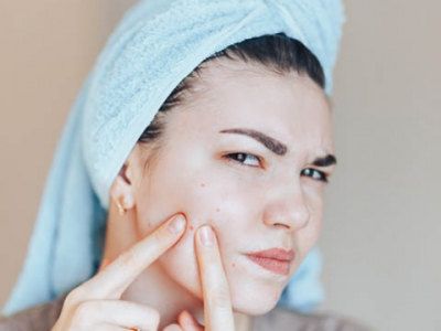 Comment réduire une forte acnée ?